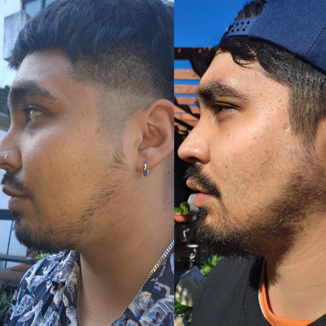 Resultados antes y después del Tónico de Crecimiento Ocean Beard